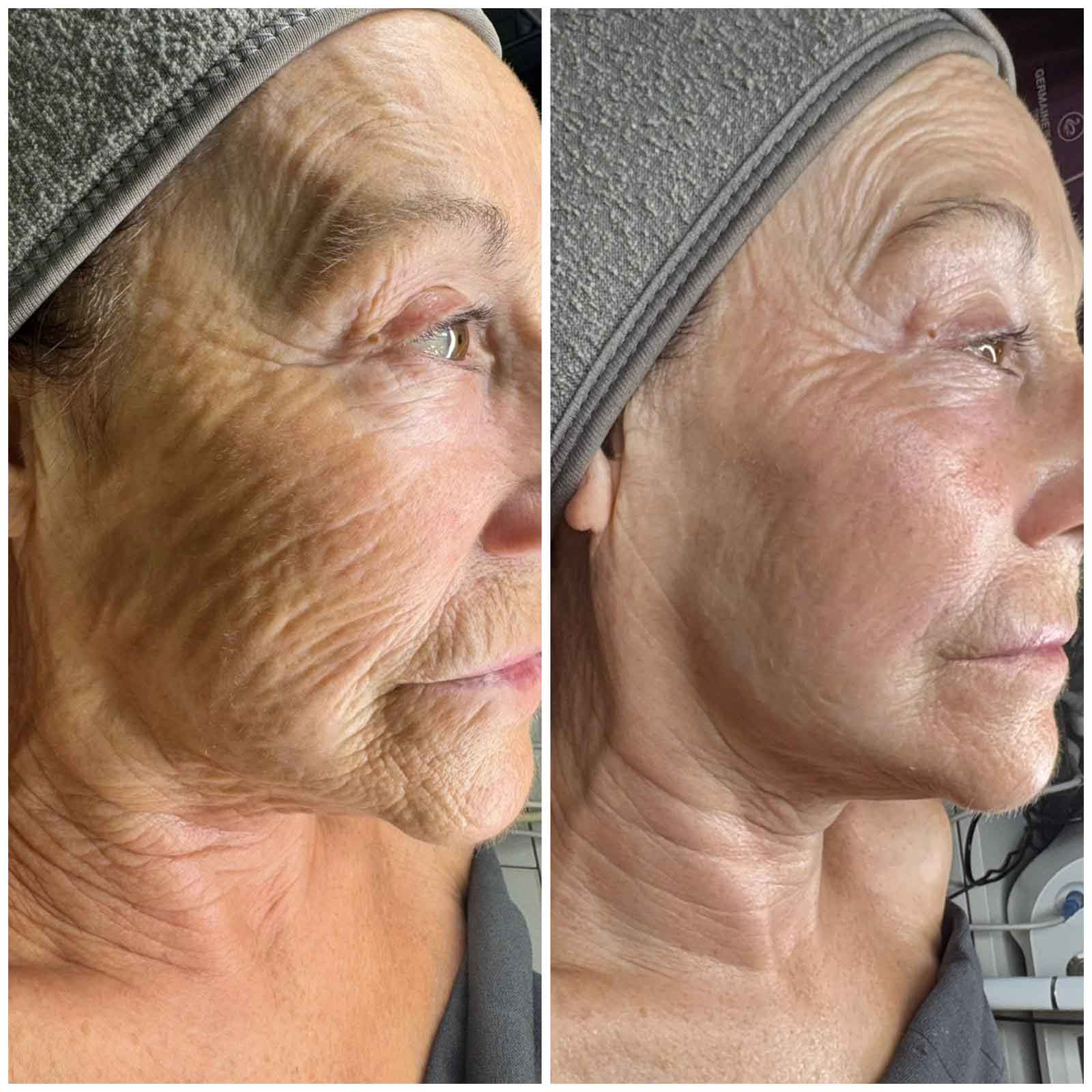Antes y después 1
